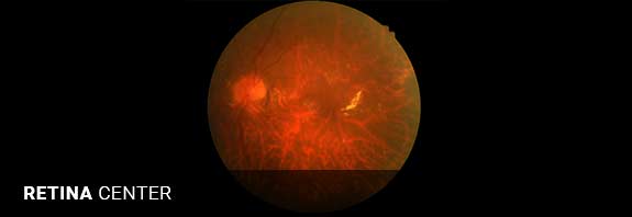 Retina Surgery Springfield MA