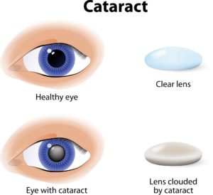 Cataract | Cataract Surgery Greenfield MA Cataract | Cataract Surgery Greenfield MA